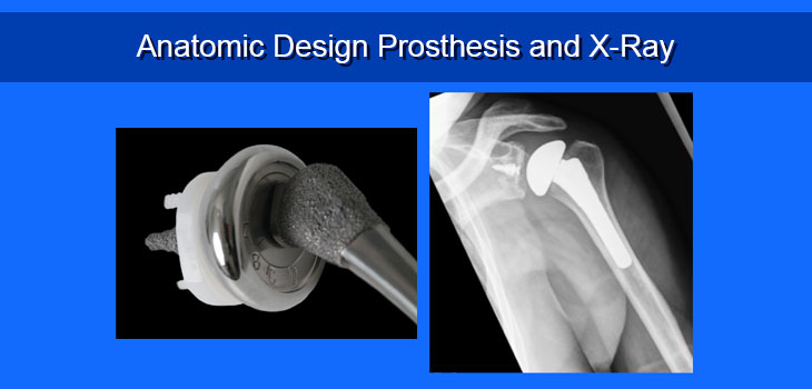 HSS Surgeon: Shoulder Arthroplasty and Reverses on the Uptick // Brown University Surgeon Helps Out in Ukraine // and More!