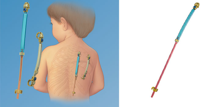 Kids With TIS (Scoliosis) Have Newly Cleared Device to Breathe Easier
