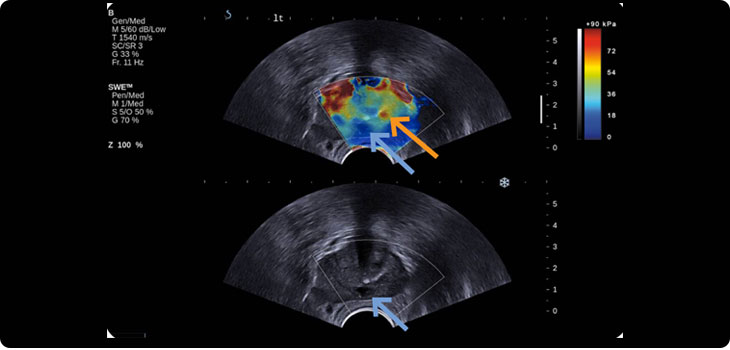 FDA Clears Two Ultrasound Probes