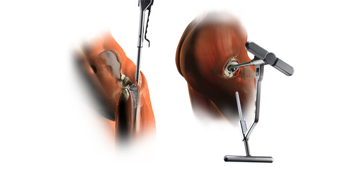 Surgeon Passes 1, 000 Arthroplasty Milestone using SuperPath