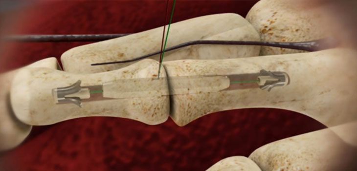 Hammertoe Correction System Gets FDA Clearance