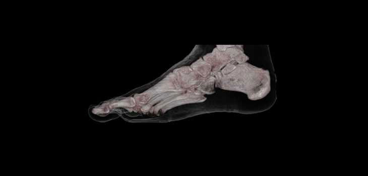 Ankle Replacement Surgery Gaining Adherents