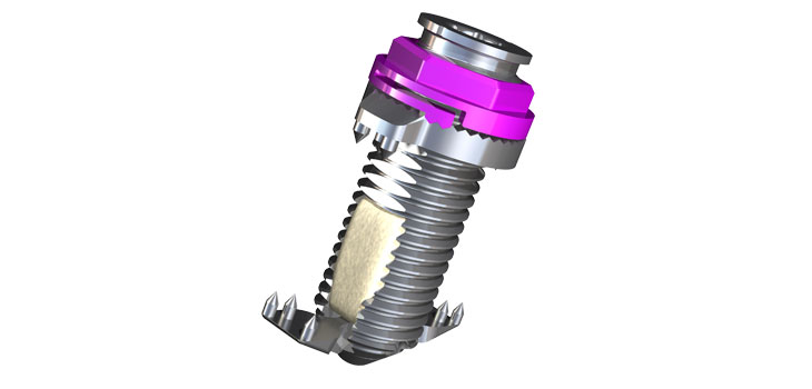 Spinal Simplicity Claims First FDA Clearance Using Percutaneous Lateral Approach