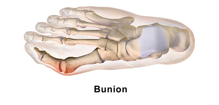 Bunion Study Identifies Risk Factors