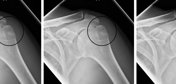 Humerus Fractures = Rotator Cuff Tears?