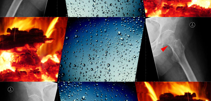 Hot Flashes, Night Sweats Linked to Low BMD