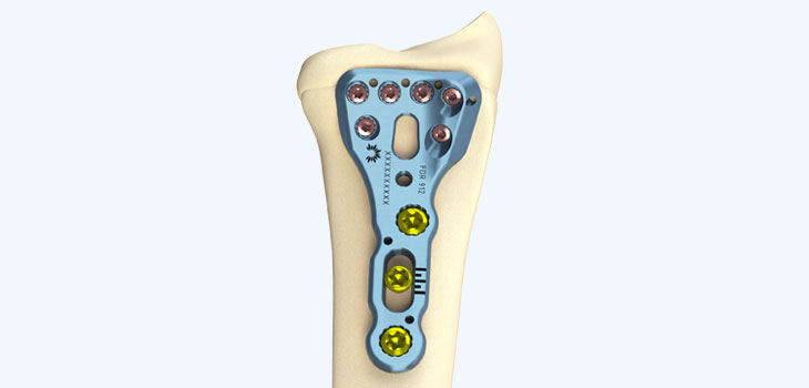 New Distal Radius Implant From Flower Orthopedics