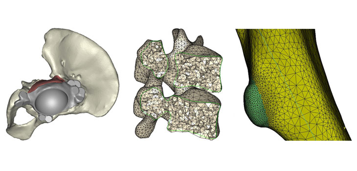3D Printing Guides Surgery in China
