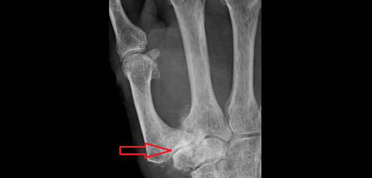 Injectable Peptide to Treat OA?
