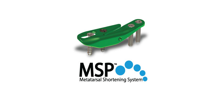 Nextremity to Launch MSP Metatarsal Shortening System