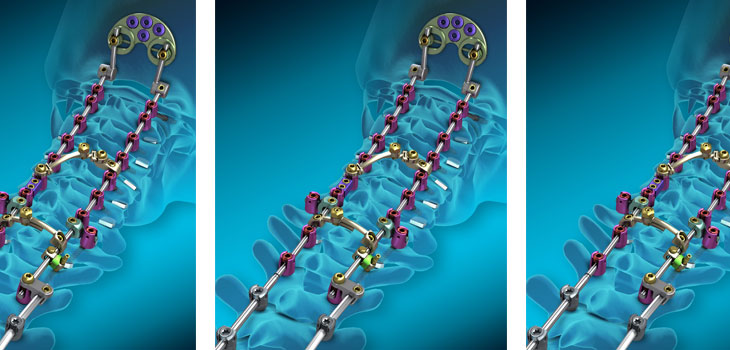 Expanded Indications for Medtronic’s Vertex Spine System