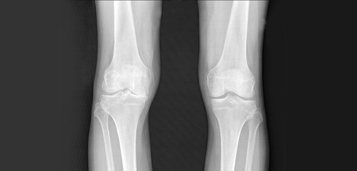Fluorescent Molecule Diagnoses, Monitors OA