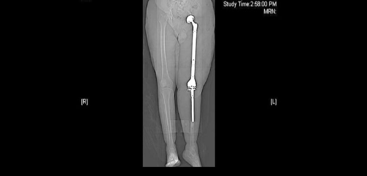 Rare Total Femoral Leg Replacement Surgery