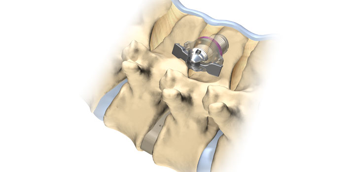 FDA Clears Spinal Simplicity’s Minuteman System