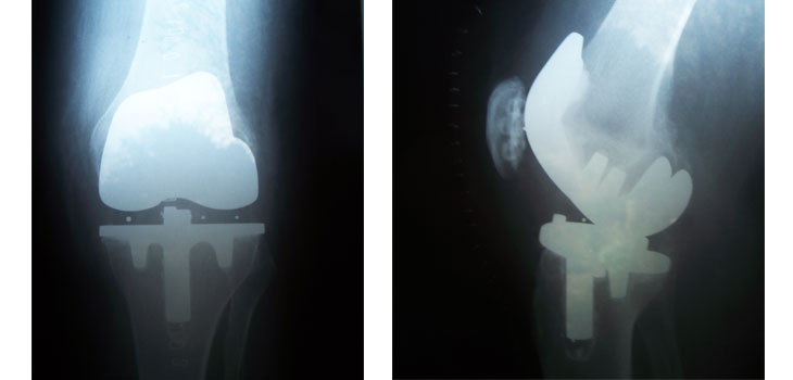 The Myth of the $87 Billion Knee Replacement Market