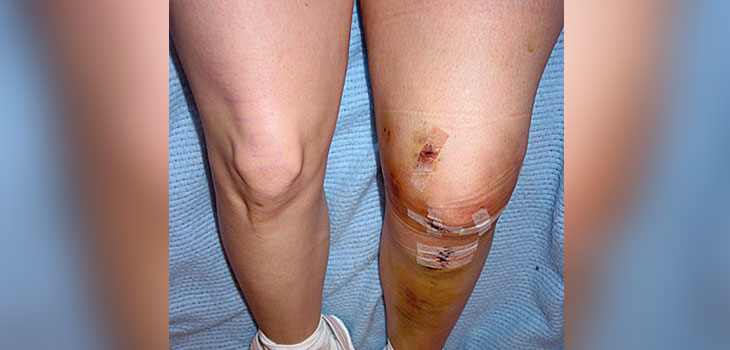 Prior ACLR Related To Knee Osteoarthritis