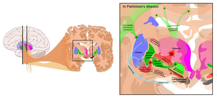 High-Tech Monitor for Parkinson’s Patients