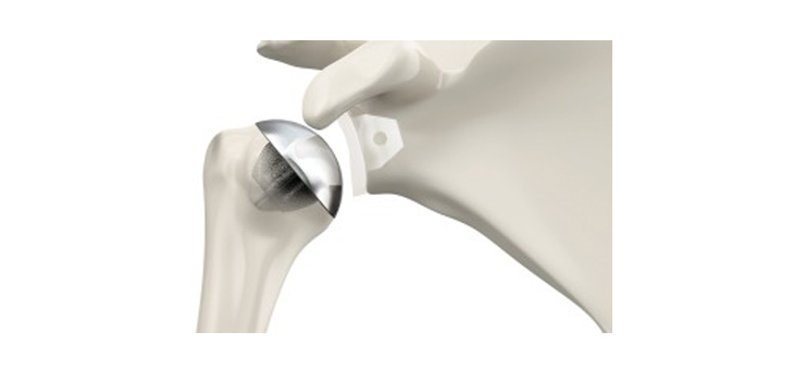Tornier’s New Shoulder for Younger, Active Patients