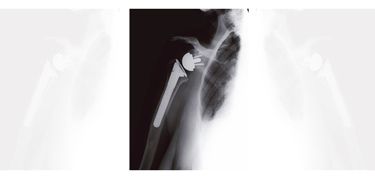 Zimmer Reports First Shoulder Use of Vivacit-E in U.S.