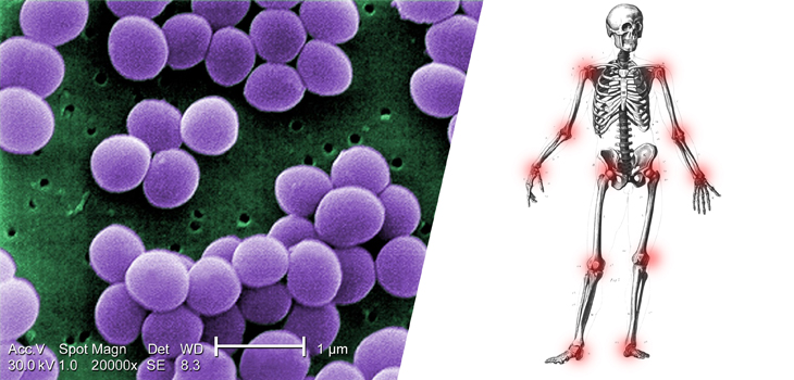 Bacterial “Clumps” Stay in Joints, Cause Infection