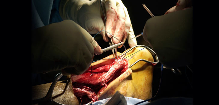 New Technique Repairs Achilles Tendon Rupture