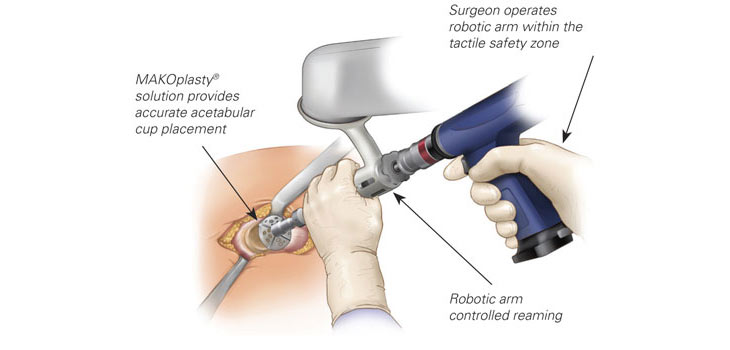 Mako’s New Hip Application FDA Cleared