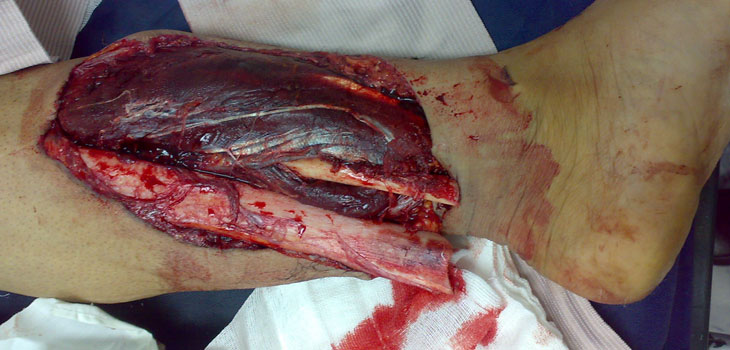 Paramedics Could Prevent Infection by Giving Antibiotics