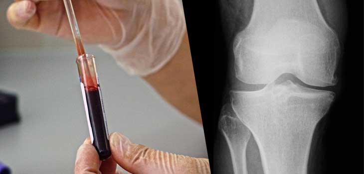 Coming Soon: First Blood Test for OA