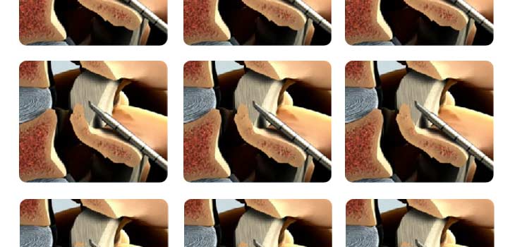 Spine Pain Study Reaches Full Enrollment