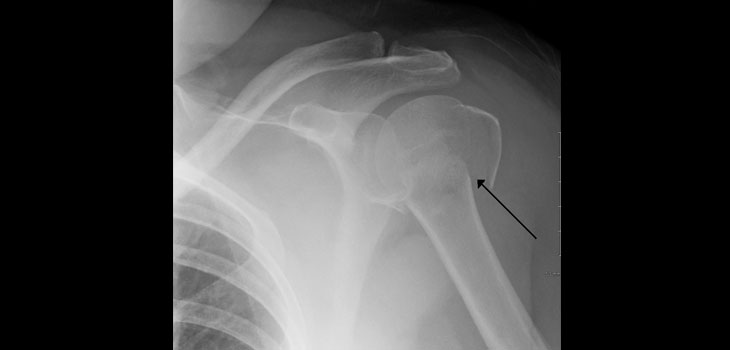 FDA Clears Cage for Proximal Humerus Fractures