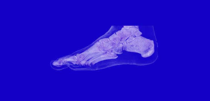 Diabetes Hampers Recovery From Ankle Surgery