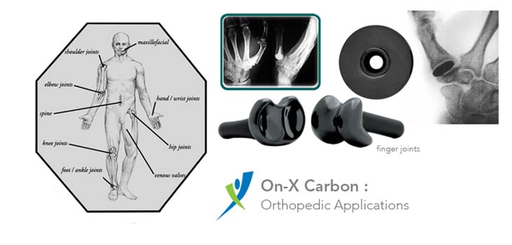 Trial Begins on Pyrolytic Carbon Knee Implant
