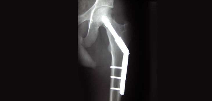 Delirium Found in 48% of Hip Fracture Patients…and It’s Expensive!