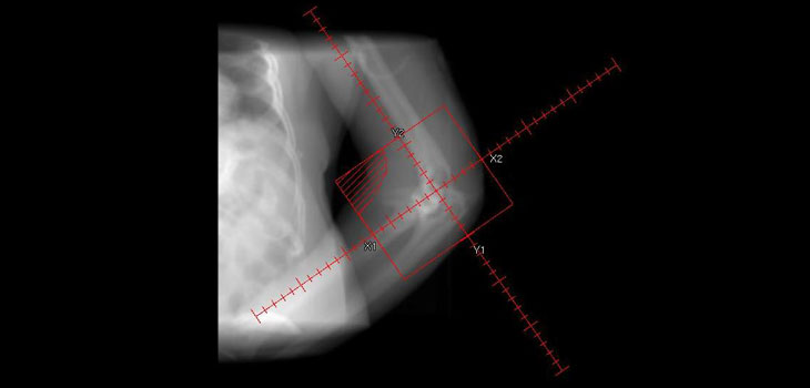 Indian Surgeon Replaces Elbow