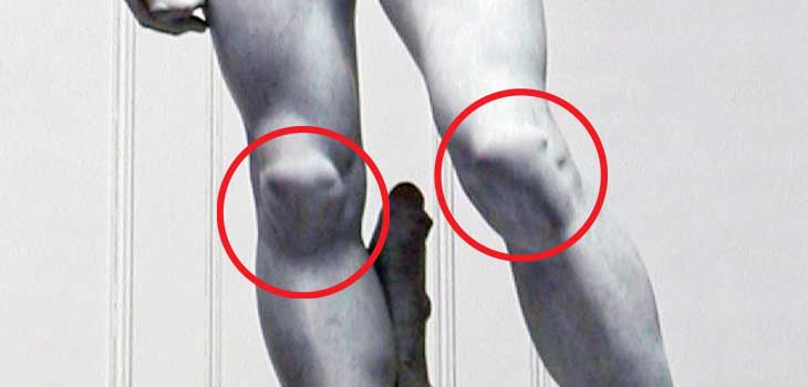 80%+ of Patients Undergoing ACI in the Patella Excellent Results // Study: AIS Patients Should Stick With High Volume Centers // and More!