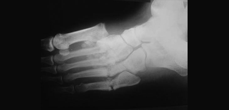 Midfoot Injuries No NFL Obstacle