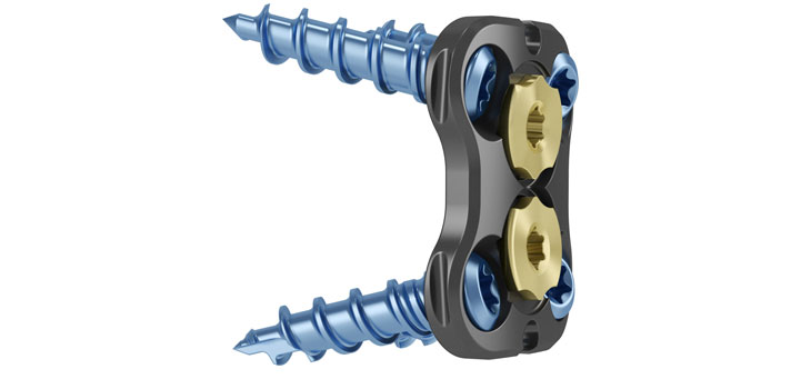 Thinner Plates for Medtronic’s Latest FDA-Cleared Cervical Plate