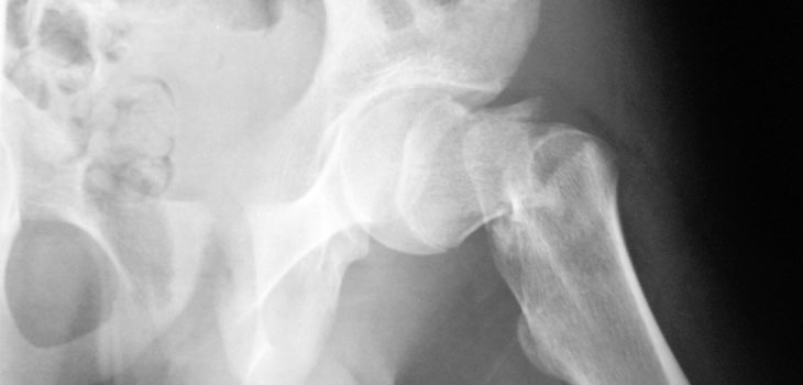 Spinal Anesthesia Best for Hip Repair