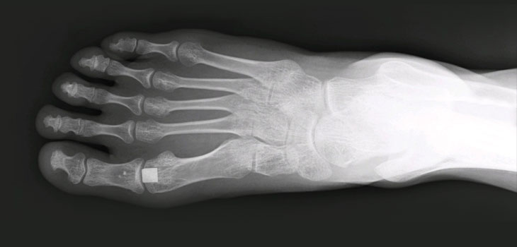 Great Toe Study Leads to FDA’s PMA