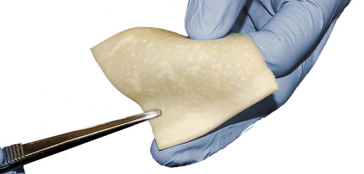 Bacterin Allograft Gets Coverage for 11.3 Million Medicare Beneficiaries