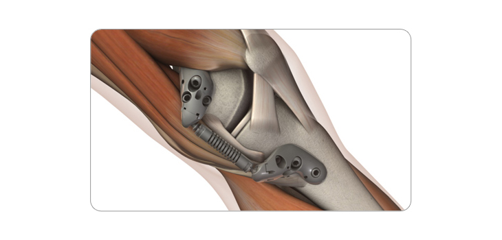 Moximed Raises $33 Million for Knee Shock Absorber