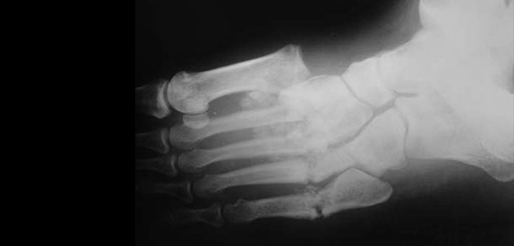 New Study Examines Use of Stem Cells for Diabetic Fractures