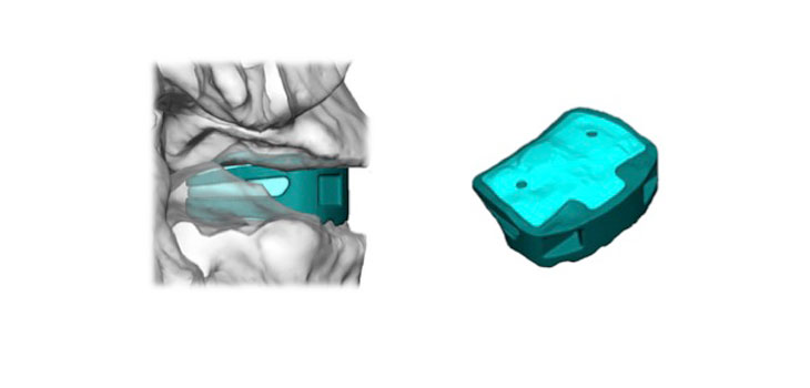 Company Claims World’s First 3D Printed Fusion Implant