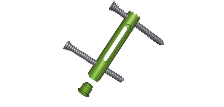 FH Ortho Receives FDA Marketing Approval for CALCAnail
