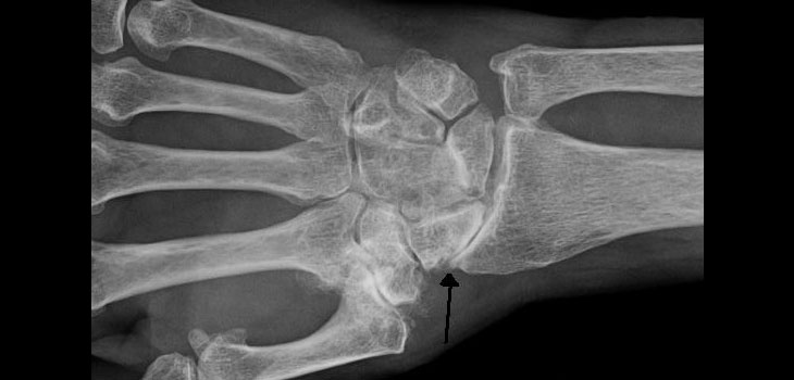 No More Hydroxychloroquine for Hand OA?