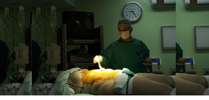Two New Studies: Bariatric Surgery Beneficial Before Joint Replacement!
