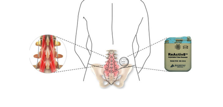 Trial Begins on Novel Spinal Neurostimulator