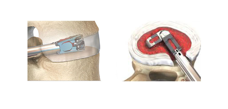 100th FLXfit Expandable Cage Implanted