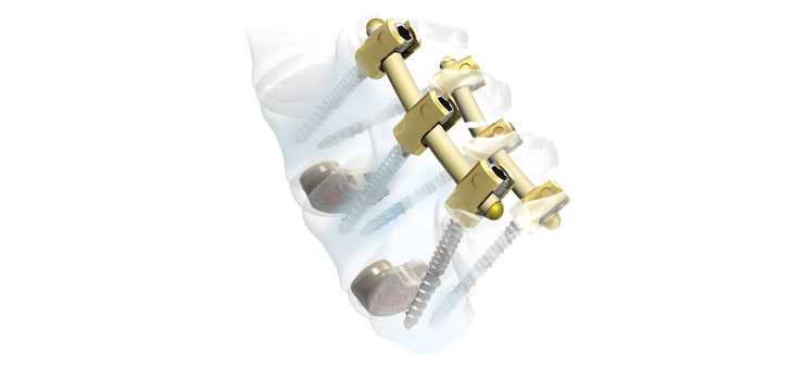 Weigao Orthopaedic Device to Utilize Invibio’s PEEK-OPTIMA