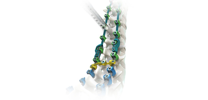 SpineCraft’s Stabilization System Cleared by FDA